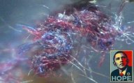 MUST SEE Morgellons MULTI VIDEO POST